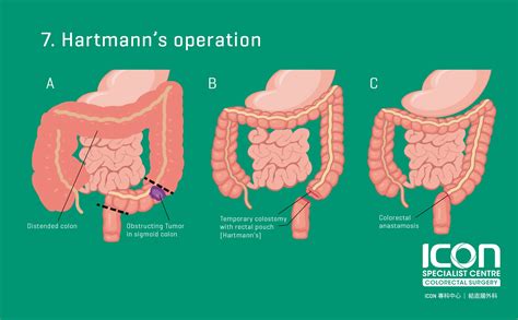 Depending on what type of surgery. . Right side pain after colon resection